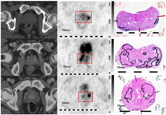 68Ga-HBED-CC-PSMA PET/CT Versus Histopathology in Primary Localized ...