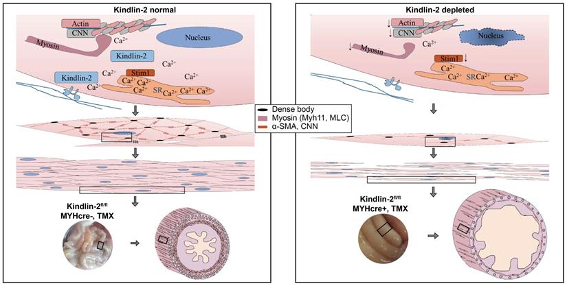 Irregular bladder smooth muscle actin-gamma 2 expression in ACTG2  mutation-associated Megacystis Microcolon Intestinal Hypoperistalsis  Syndrome (MMIHS): A case report