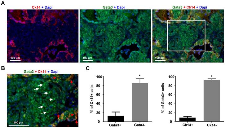 Loss Of Function Of GATA3 Induces Basal like Mammary Tumors