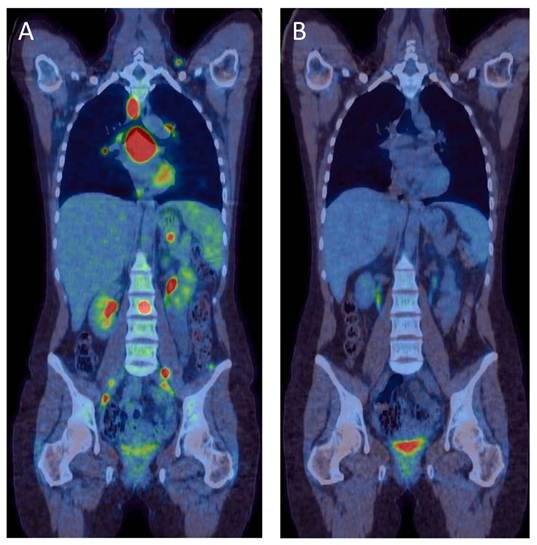 How Does the Patient Benefit from Clinical PET?