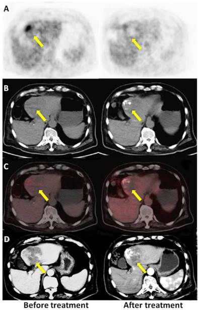 The Prognostic Value of 18F-FDG PET/CT for Hepatocellular Carcinoma ...