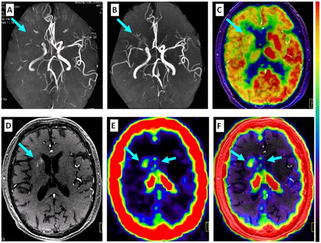 Application of 68Ga-PRGD2 PET/CT for αvβ3-integrin Imaging of ...
