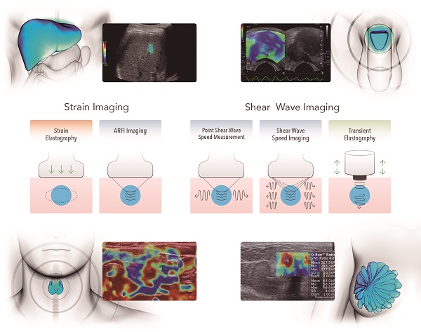 Ultrasound Elastography Educational Materials Siemens