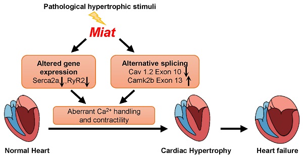 hypertrophy of the heart